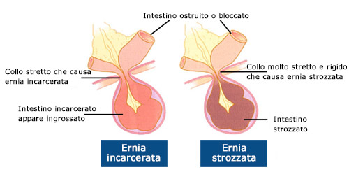 Ernia inguinale: quando preoccuparsi