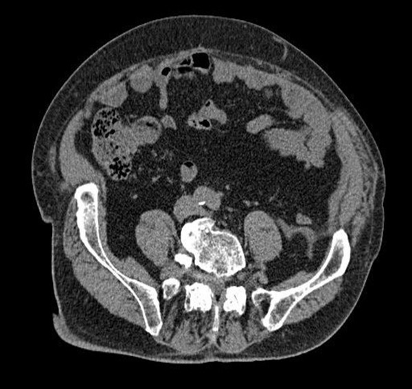 Tac Postoperatoria 1