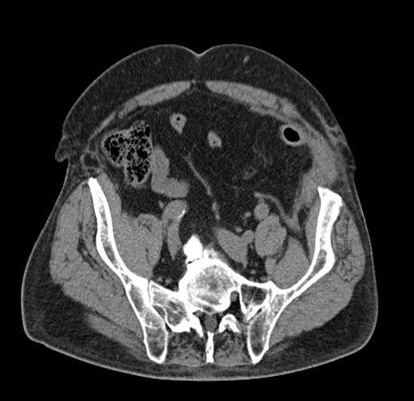 Tac Postoperatoria 2