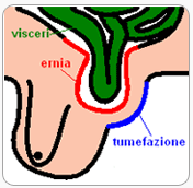 ernia-inguinale
