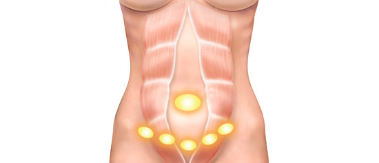 Floppy Abdomen post-partum